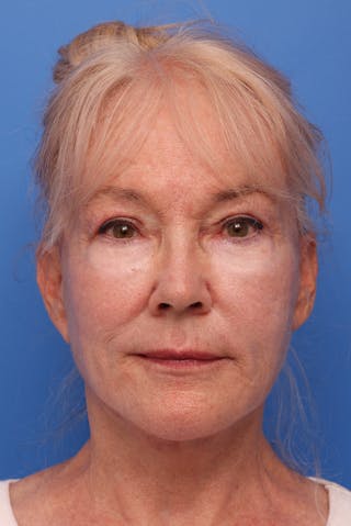 Deep Plane Facelift Before & After Gallery - Patient 130779 - Image 4