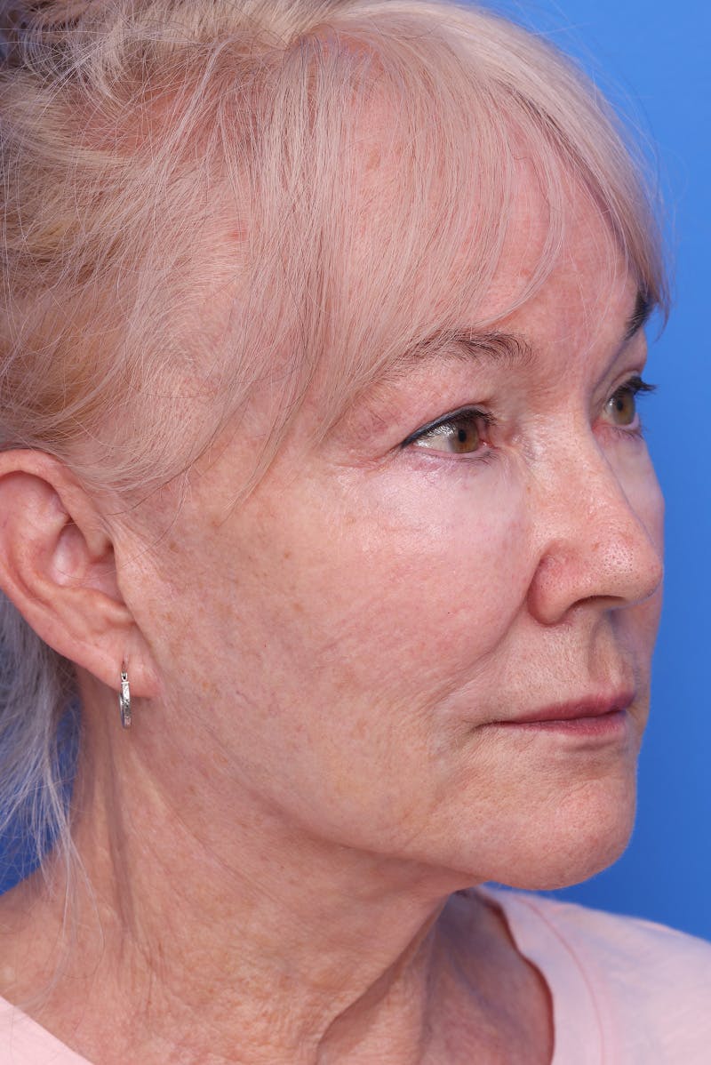 Neck Lift Before & After Gallery - Patient 167665 - Image 4