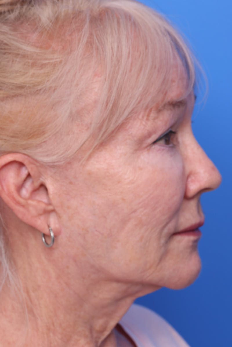 Neck Lift Before & After Gallery - Patient 167665 - Image 7