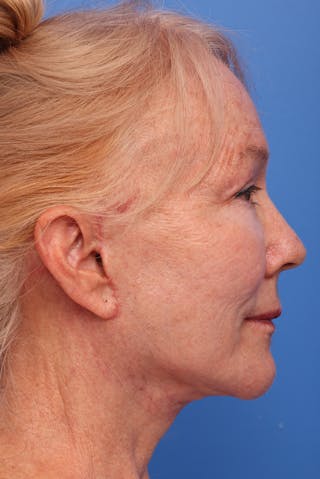 Deep Plane Facelift Before & After Gallery - Patient 130779 - Image 10