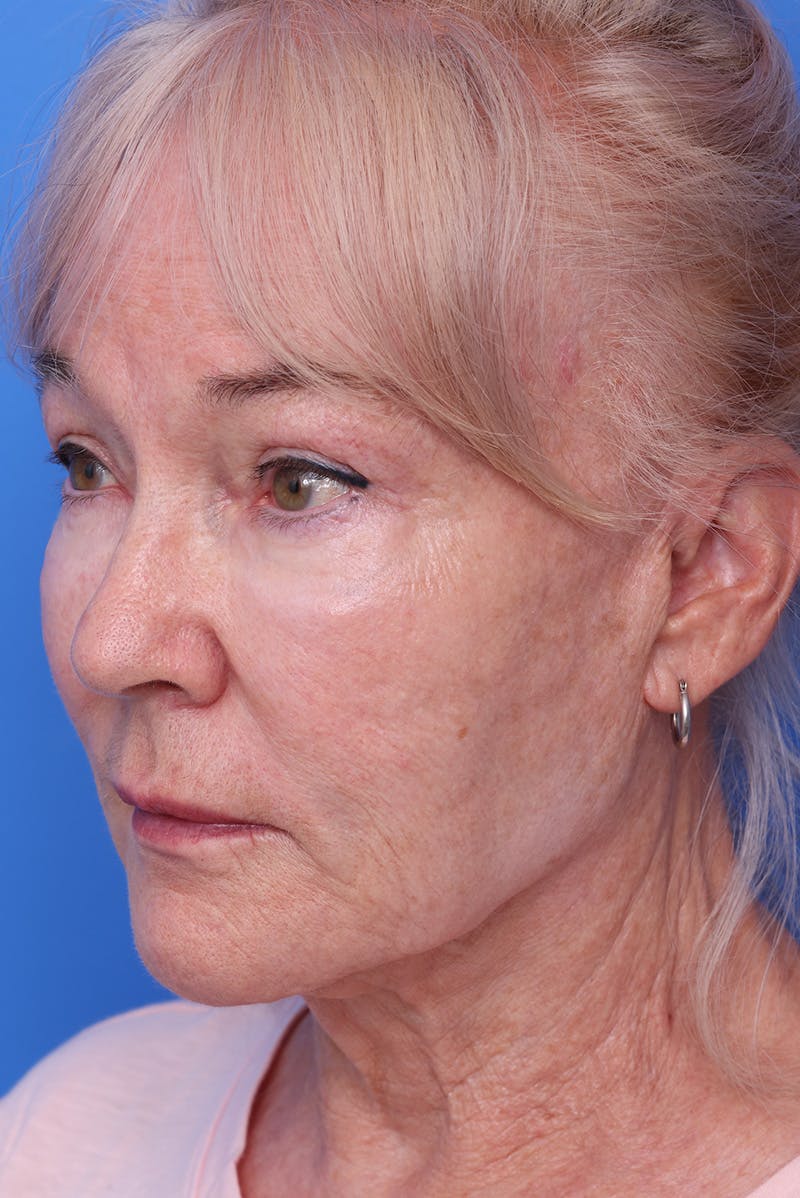 Neck Lift Before & After Gallery - Patient 167665 - Image 5