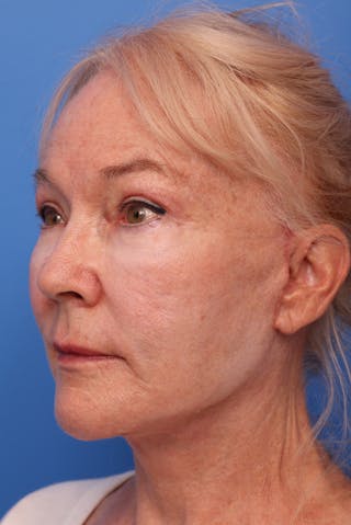 Deep Plane Facelift Before & After Gallery - Patient 130779 - Image 8