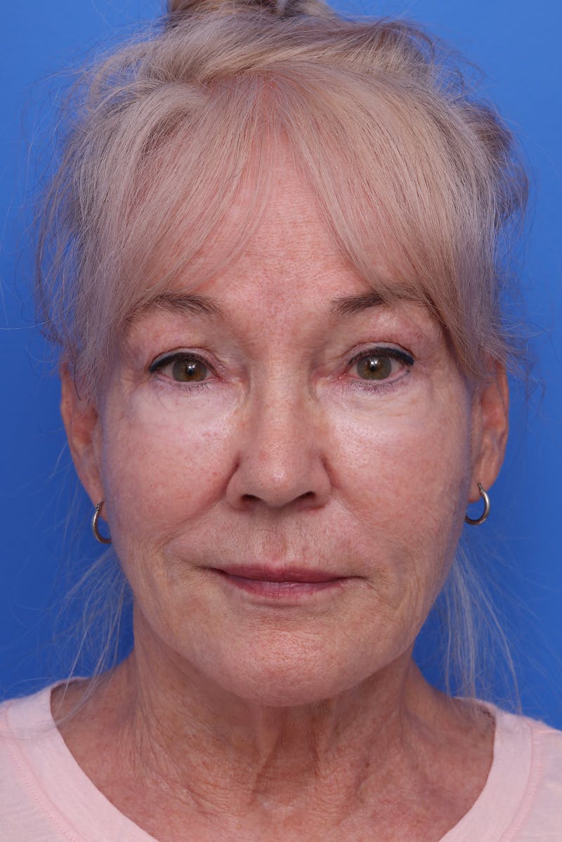 Neck Lift Before & After Gallery - Patient 167665 - Image 1