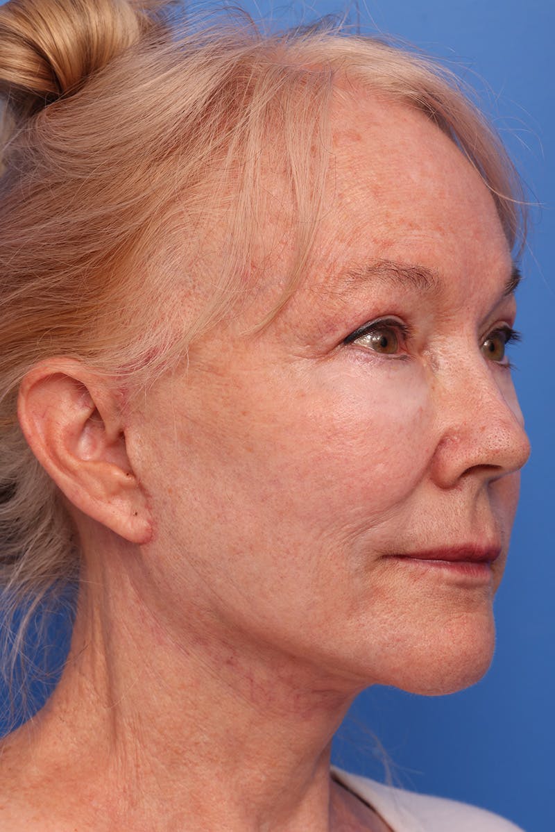 Neck Lift Before & After Gallery - Patient 167665 - Image 3