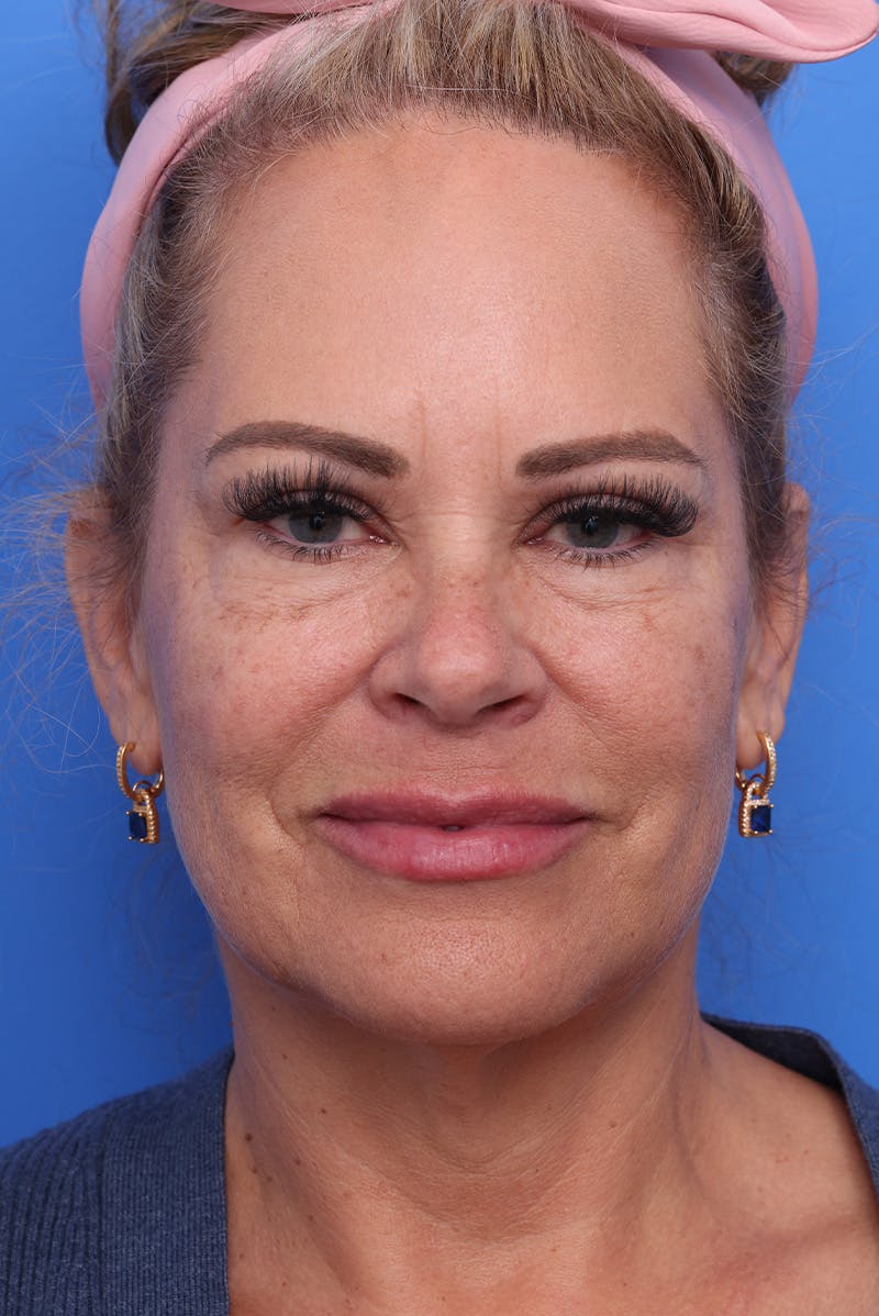 Deep Plane Facelift Before & After Gallery - Patient 812164 - Image 1