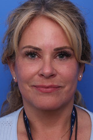 Laser Skin Resurfacing Before & After Gallery - Patient 977429 - Image 2