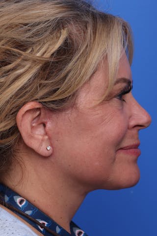 Laser Skin Resurfacing Before & After Gallery - Patient 977429 - Image 6