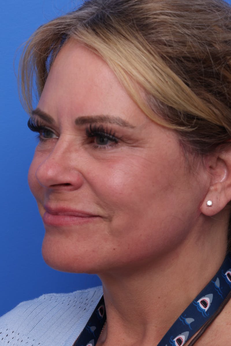 Deep Plane Facelift Before & After Gallery - Patient 812164 - Image 8
