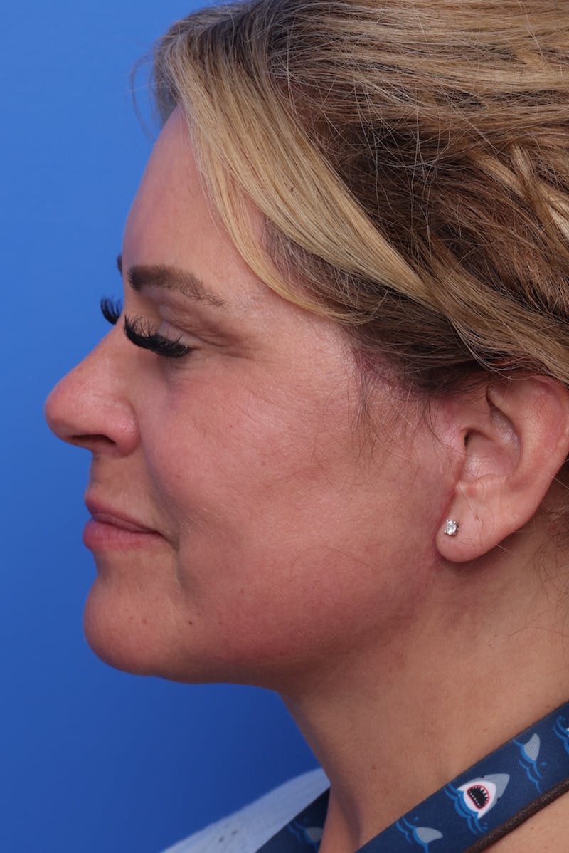 Deep Plane Facelift Before & After Gallery - Patient 812164 - Image 10