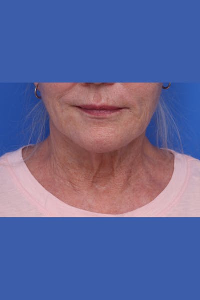 Neck Lift Before & After Gallery - Patient 167665 - Image 1