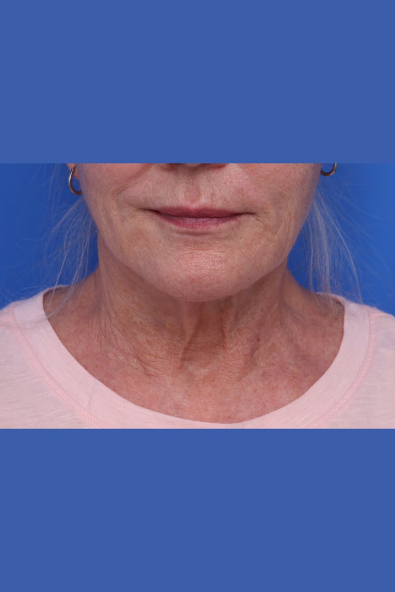 Deep Plane Facelift Before & After Gallery - Patient 130779 - Image 1