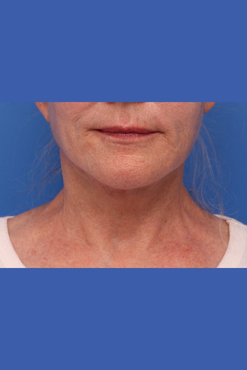 Deep Plane Facelift Before & After Gallery - Patient 130779 - Image 2