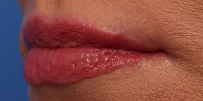 Lip Lift Before & After Gallery - Patient 746461 - Image 6