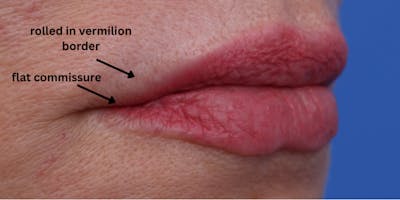 Lip Lift Before & After Gallery - Patient 746461 - Image 1