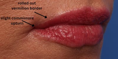 Lip Lift Before & After Gallery - Patient 746461 - Image 2