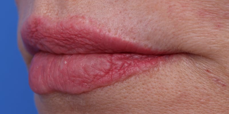 Lip Lift Before & After Gallery - Patient 746461 - Image 5