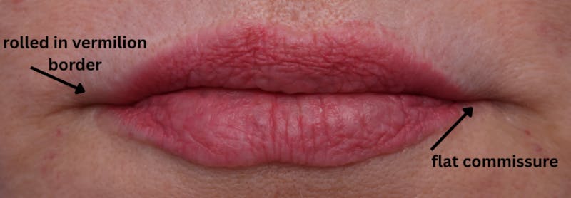 Lip Lift Before & After Gallery - Patient 746461 - Image 3