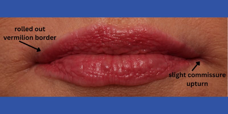 Lip Lift Before & After Gallery - Patient 746461 - Image 4