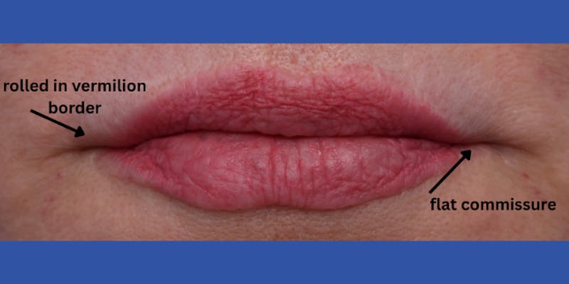 Lip Lift Before & After Gallery - Patient 746461 - Image 3