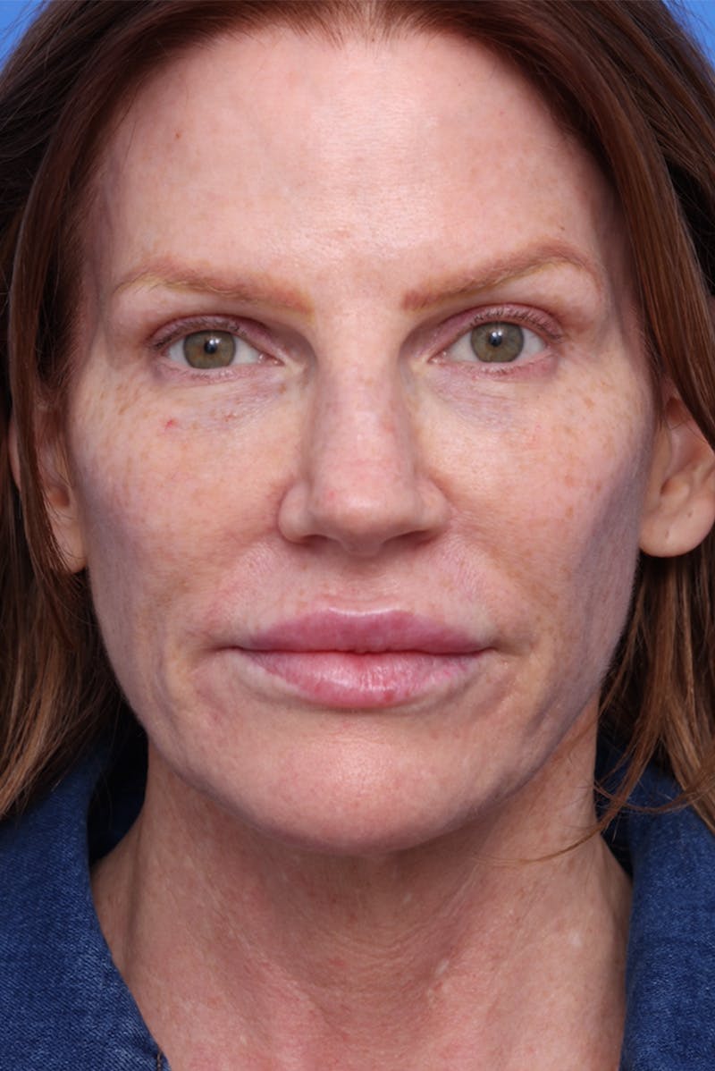 Deep Plane Facelift Before & After Gallery - Patient 387302 - Image 1