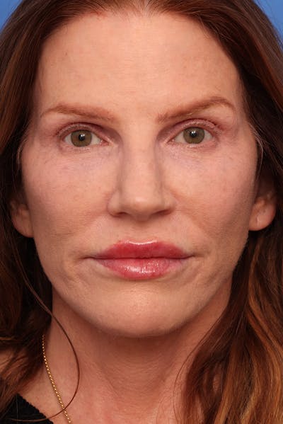 Neck Lift Before & After Gallery - Patient 325045 - Image 2