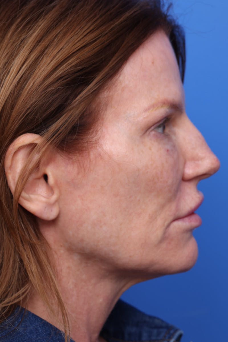 Deep Plane Facelift Before & After Gallery - Patient 387302 - Image 3
