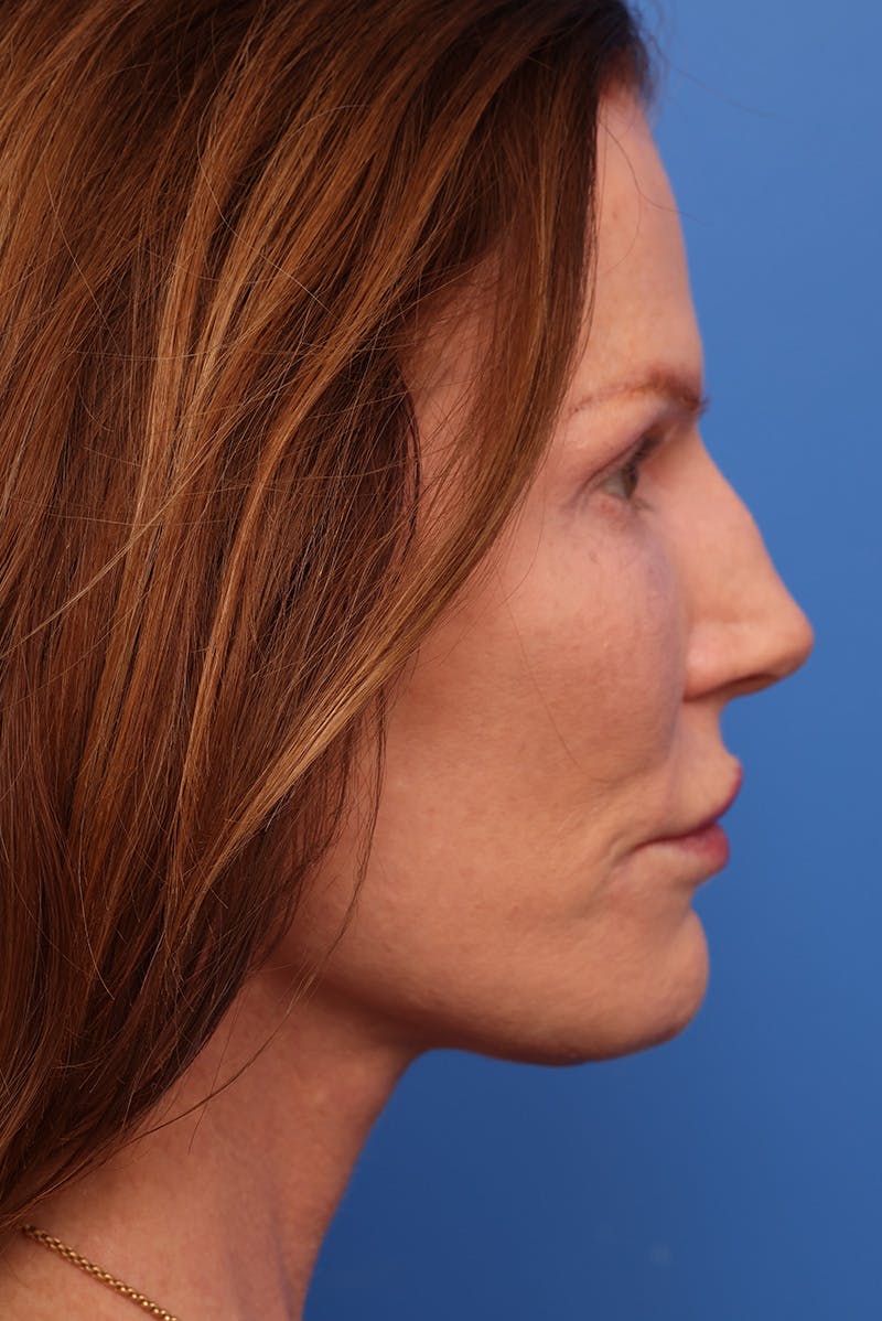 Deep Plane Facelift Before & After Gallery - Patient 387302 - Image 4