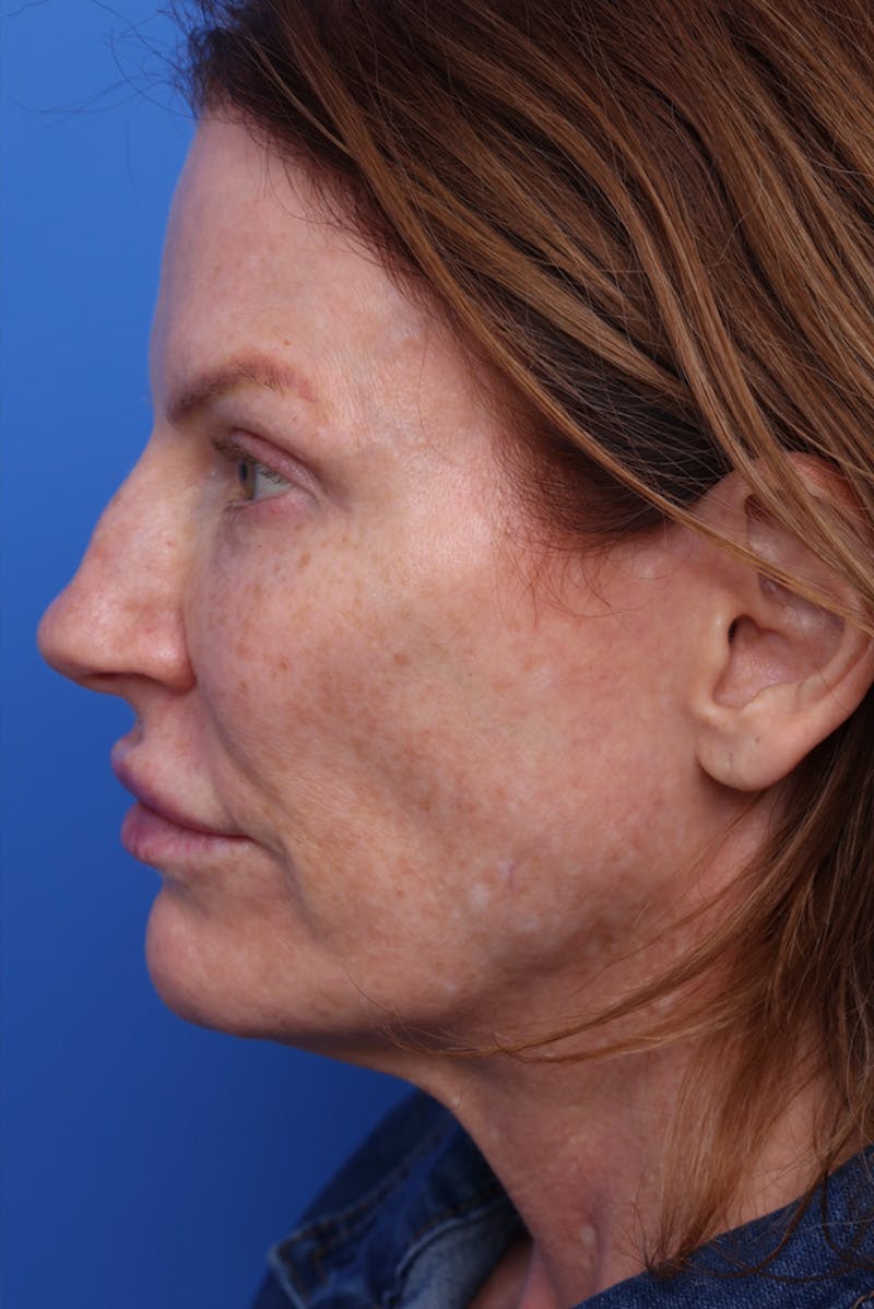 Deep Plane Facelift Before & After Gallery - Patient 387302 - Image 5