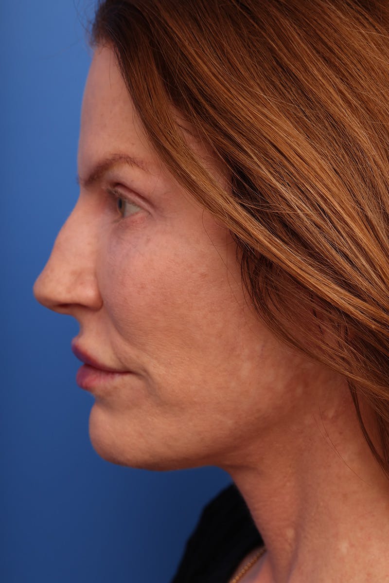 Deep Plane Facelift Before & After Gallery - Patient 387302 - Image 6