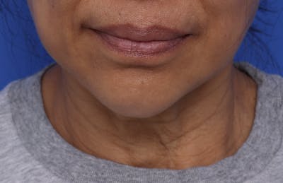 Facial Implants (Chin, Cheek, Midface) Before & After Gallery - Patient 649903 - Image 1