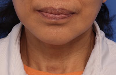 Facial Implants (Chin, Cheek, Midface) Before & After Gallery - Patient 649903 - Image 2