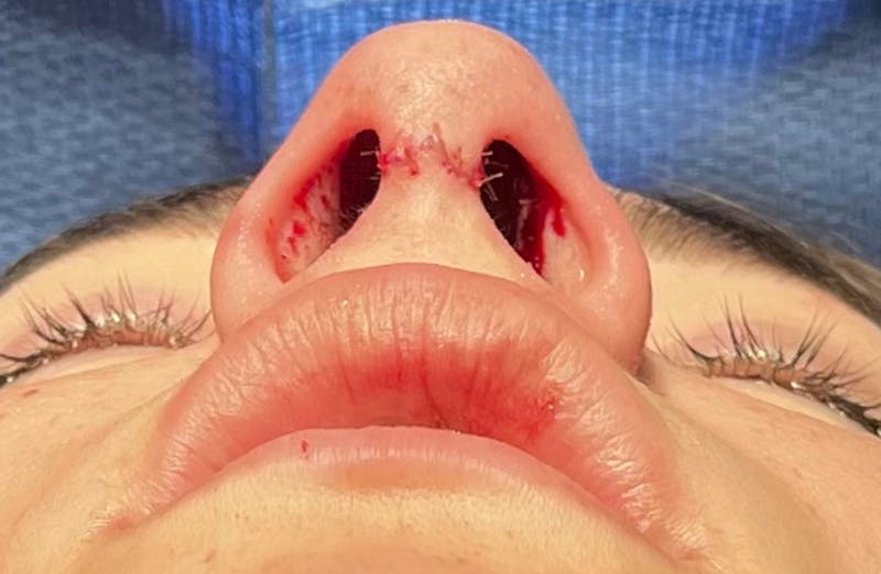 Rhinoplasty Before & After Gallery - Patient 399963 - Image 4