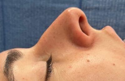 Rhinoplasty Before & After Gallery - Patient 399963 - Image 1