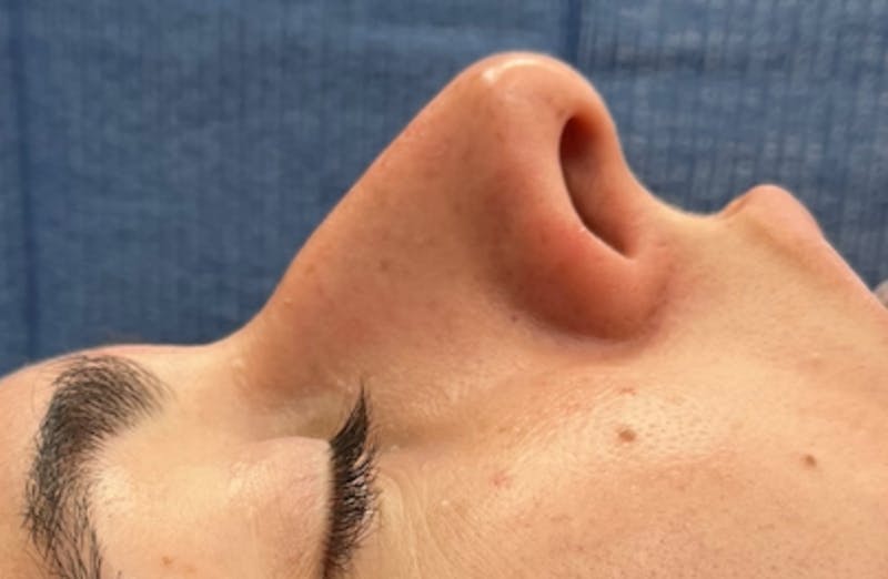 Rhinoplasty Before & After Gallery - Patient 399963 - Image 1