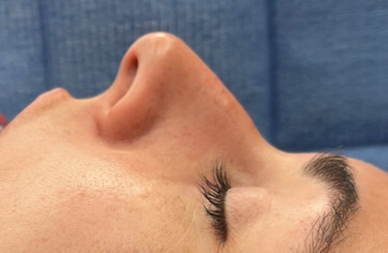 Rhinoplasty Before & After Gallery - Patient 399963 - Image 5