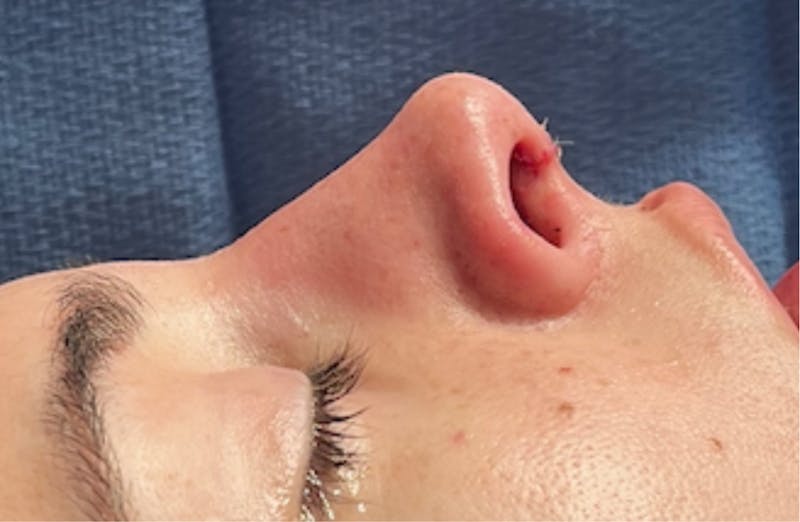 Rhinoplasty Before & After Gallery - Patient 399963 - Image 2