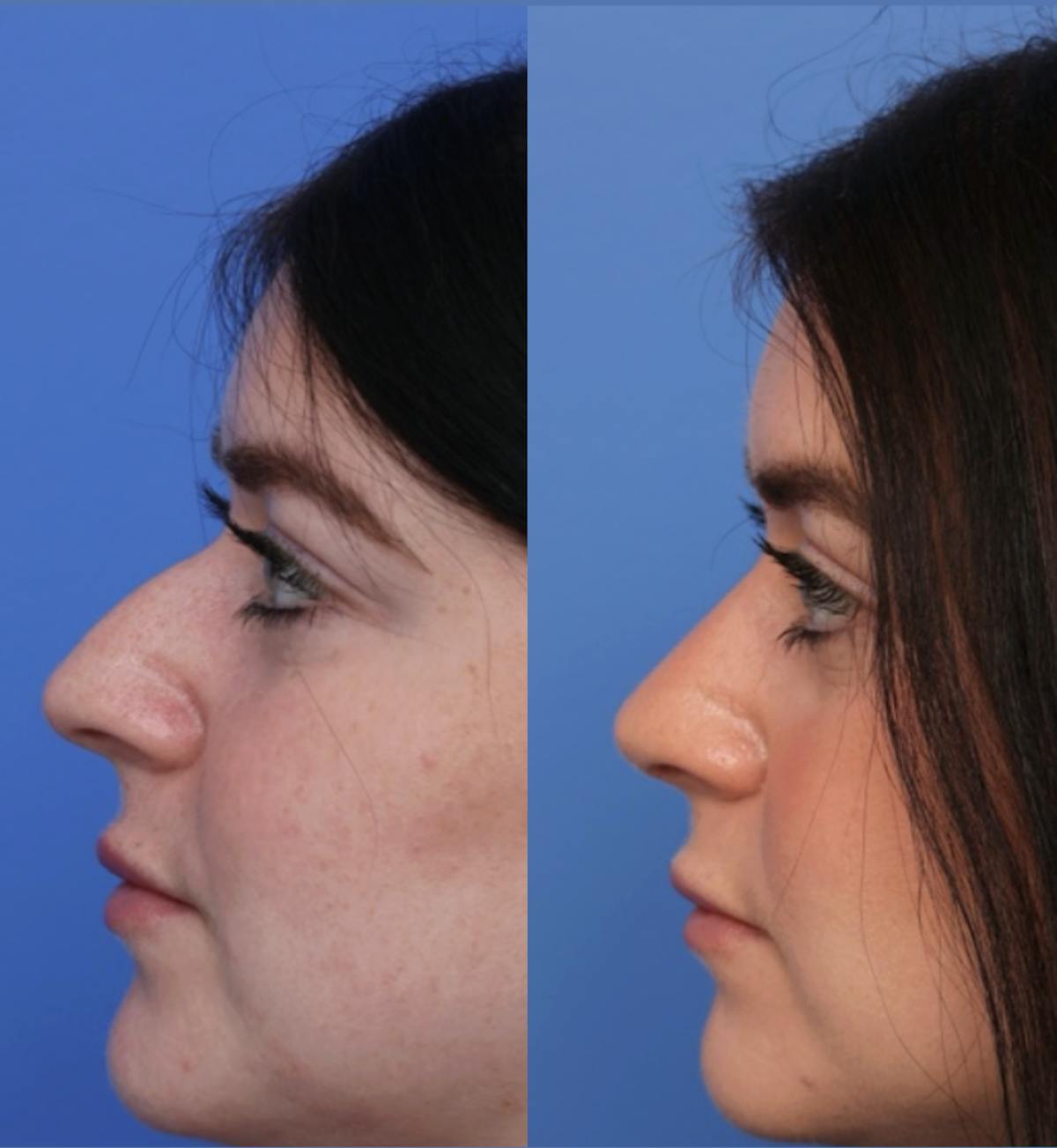 Rhinoplasty Before & After Gallery - Patient 299025 - Image 1