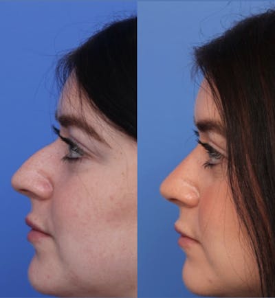Rhinoplasty Before & After Gallery - Patient 299025 - Image 1