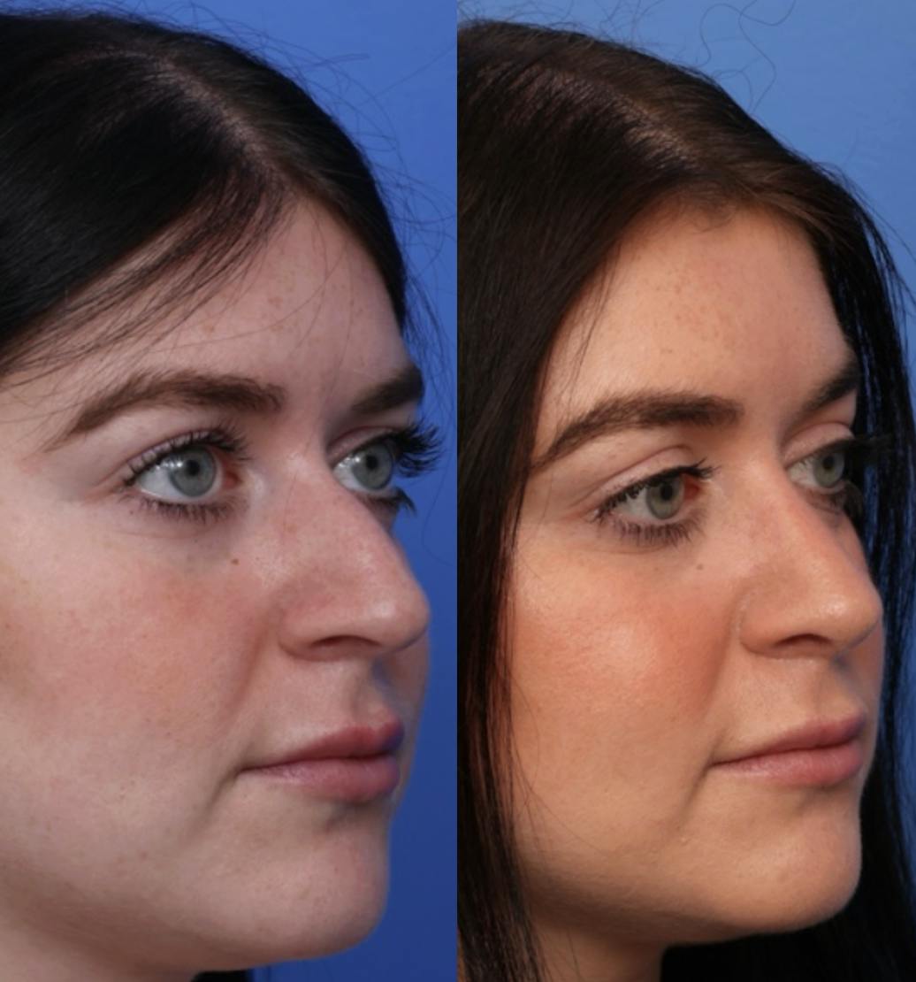Rhinoplasty Before & After Gallery - Patient 299025 - Image 3