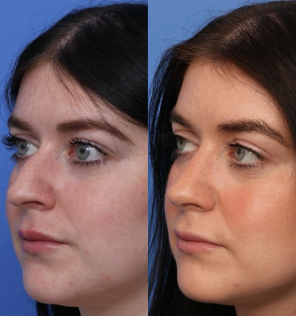 Rhinoplasty Before & After Gallery - Patient 299025 - Image 2