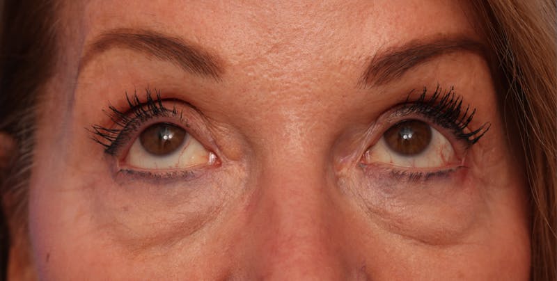 Lower Eyelid Lift Before & After Gallery - Patient 386742 - Image 3