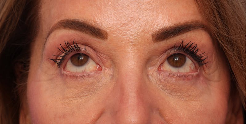 Lower Eyelid Lift Before & After Gallery - Patient 386742 - Image 4