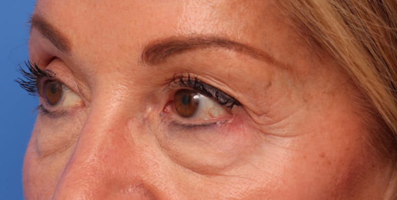 Lower Eyelid Lift Before & After Gallery - Patient 386742 - Image 1