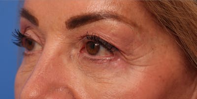 Lower Eyelid Lift Before & After Gallery - Patient 386742 - Image 2