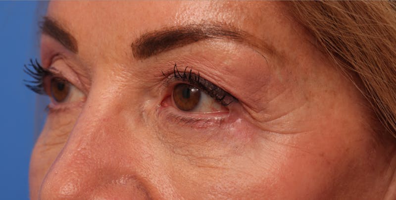 Lower Eyelid Lift Before & After Gallery - Patient 386742 - Image 2