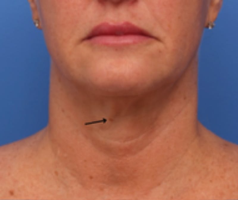 Neck Lift Before & After Gallery - Patient 342322 - Image 1