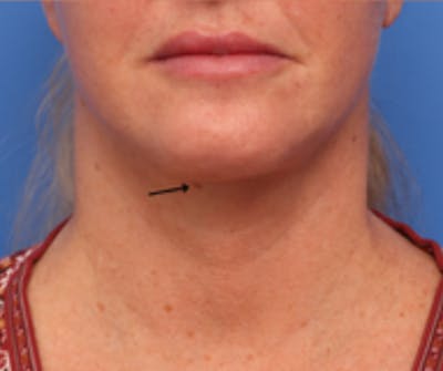 Neck Lift Before & After Gallery - Patient 342322 - Image 2