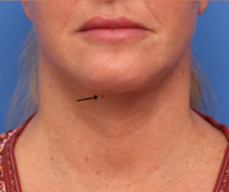 Neck Lift Before & After Gallery - Patient 342322 - Image 2