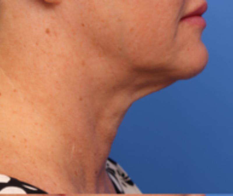 Neck Lift Before & After Gallery - Patient 342322 - Image 3