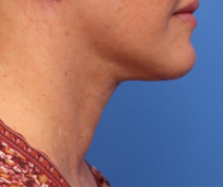 Neck Lift Before & After Gallery - Patient 342322 - Image 4